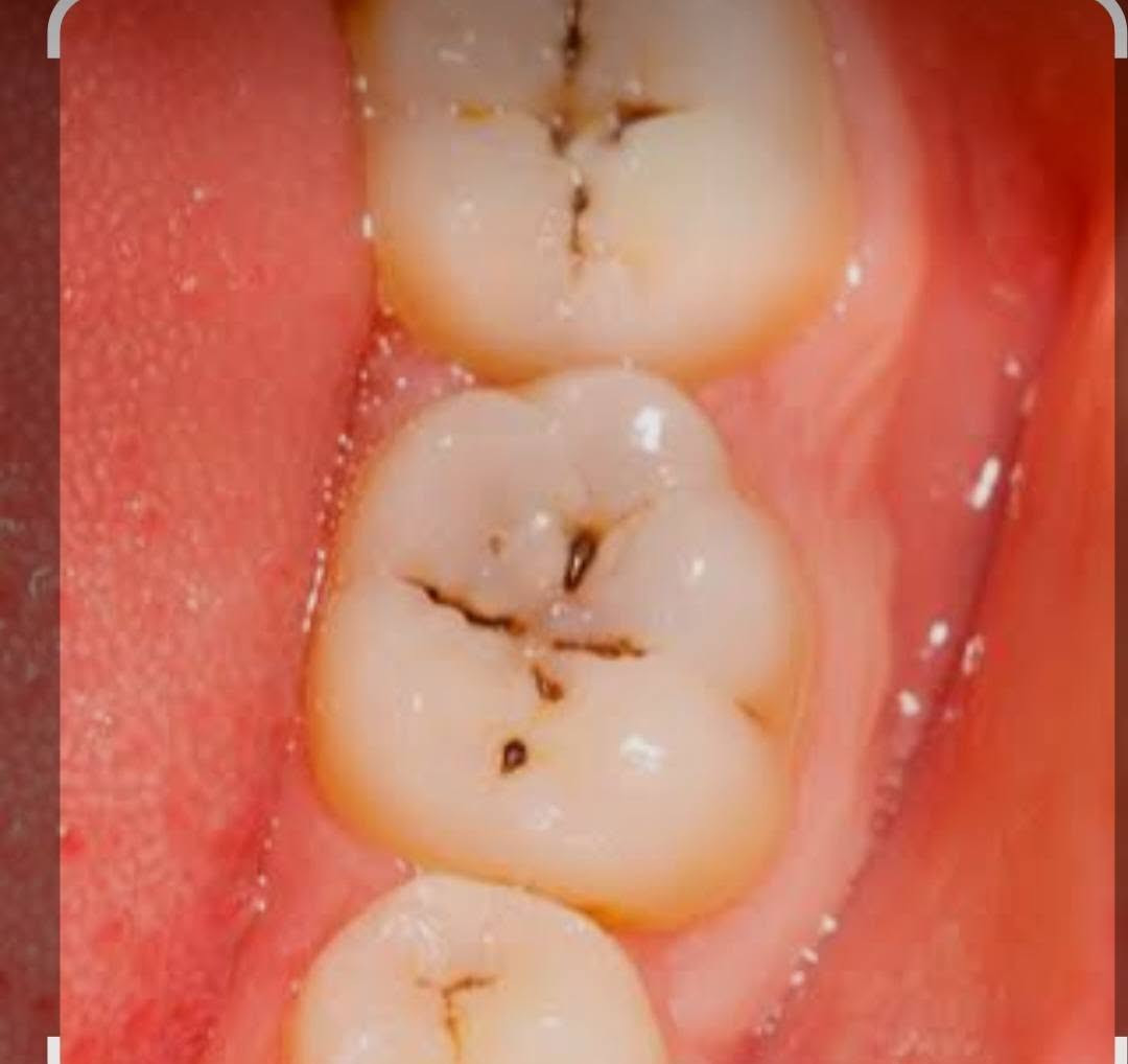 تسوسات اسنان • علاج مجاني • جامعة ابن سينا