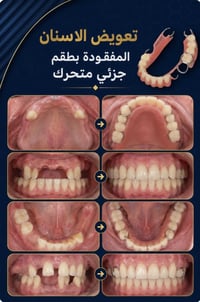 طقم جزئي • بأقل التكاليف • جامعة كربلاء