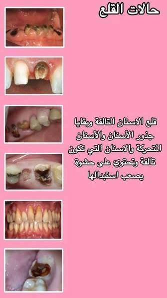 🦷🖤

يسرّني استقبالكم في عيادات الأسنان لتقديم خدمات طب وجراحة الفم والأسنان بأحدث التقنيات وبعناية متكاملة.

🔹 استقبل قلع الاسنان هكذا حالات كما موضح في الصور
🔹 حشوات مؤقتة ودائمية
🔹 طب أسنان الأطفال
بأشراف نخبة من الاطباء المختصين

👨‍⚕️ الدكتور علي عدنان رزيق 

📞 للحجز والاستفسار:*********** او مراسلة الصفحة 
📍 حلة – شارع 40، عيادات جامعة الحله مجاور صيدلية سلامتك
علما إن العلاج مجاني بلكامل