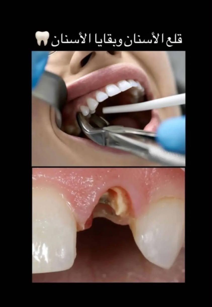 مرحـبًا ، اي احد منكم او اهلكم محتاج معالجة لاسنانهم ، تـوجد عيادات مـجانية في جامعة المصطفى -شارع فـلسطين الموال -قرب الجامعة المستنصرية
مرحـبًا ، اي احد منكم او اهلكم محتاج معالجة لاسنانهم ، تـوجد عيادات مـجانية في جامعة المصطفى -شارع فـلسطين الموال -قرب الجامعة المستنصرية 

-حشوات ضوئية 
-قلع الأسنان و بقايا الجذور
-تنظيف الأسنان و إزالة التصبغات و التكلسات
-تعويض الأسنان بالطقم الجزئي المتحرك 
عـلمًا ان العمل تحت اشراف اطباء اختصاص ، للحجز التواصل عن طريق الحساب او واتساب عن طريق الرقم ‭***********‬

نص مكتوب في الصور:
- balm dentist طبيبة أسنان حشوات ضوئية قلع الأسنان و بقايا الجذور تنظيف الأسنان و إزالة التصبغات و التَكلسات تعويض الأسنان بالطقم الجزئي المتحرك عيادات جامعة المصطفى - شارع فلسطين قرب الجامعة المستنصرية
- تنظيف الاسنان من التصبغات والتكلسات
- الحالات اللي راح نشتغلها حشوات ضوئيه Before After
- قلع الأسنان وبقايا الأسنان 🦷
- تعويض الاسنان المفقوده بتركيب جزئي متحرك 🦷
- Before
- After