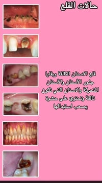 عيادات أسنان • شارع 100 • قلع أسنان