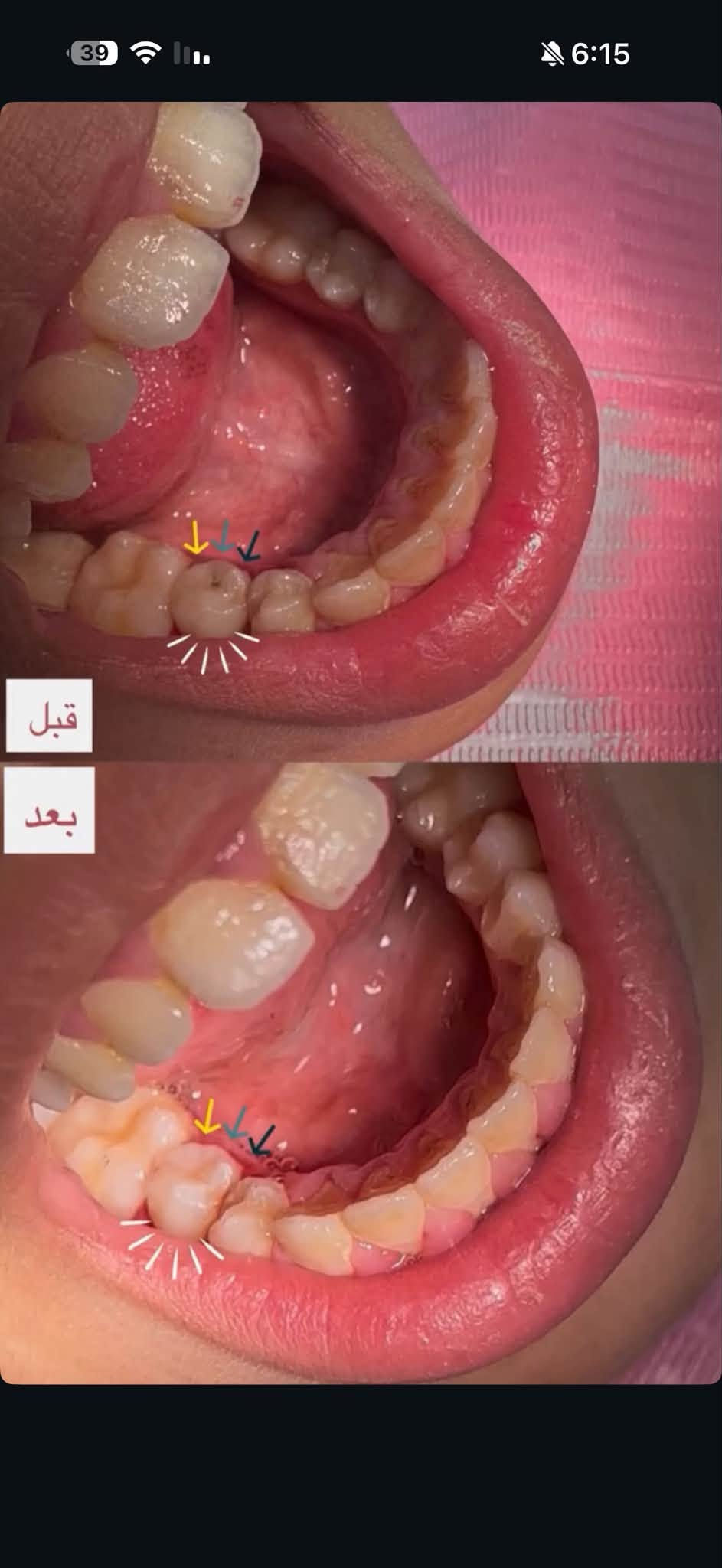 تنظيف اسنان • مجانا • جامعة الزهراوي