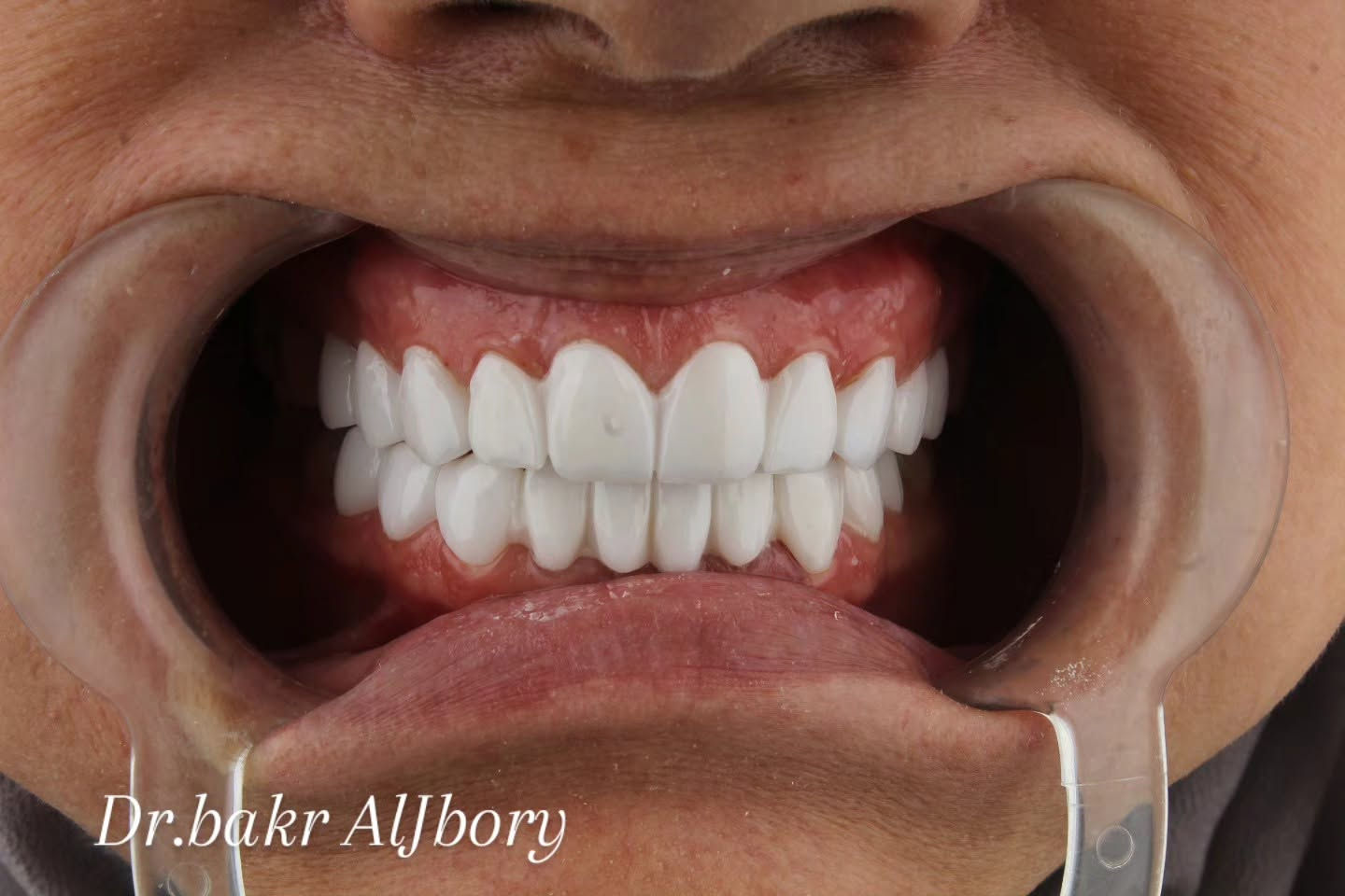 ابتسامة هوليوود • د بكر الجبوري • تجميل اسنان
