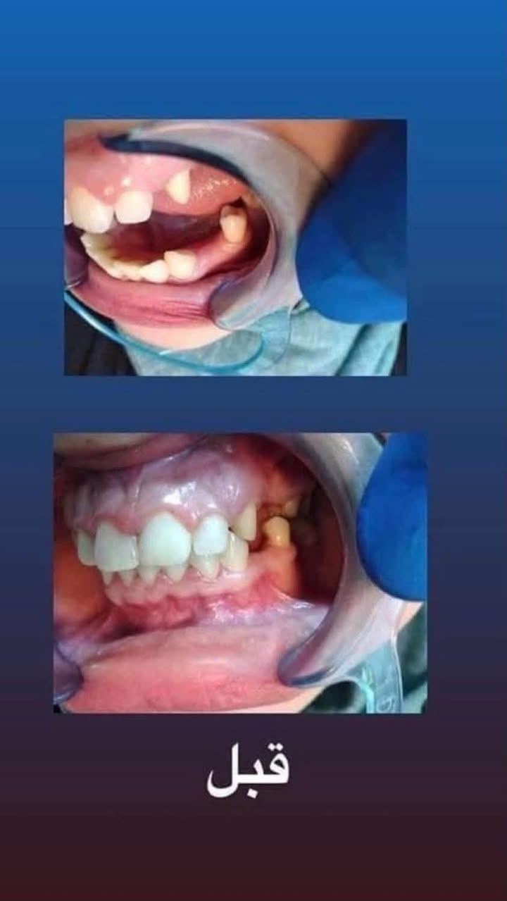 اللي يريد يحجز يتصل او يدز عالخاص
عيادة طب الاسنان 
تقويم الاسنان ،، زراعة الاسنان ،، حشوات تجميلية
تركيب الاسنان (سيراميك و زارگون)،، حشوات جذور ،، قلع،، حشوات مؤقتة ودائمية ،، تنظيف وتلميع الاسنان ،، تبييض الاسنان بالليزر 
متواجدين طيلة أيام الاسبوع 
للحجز والاستفسار ع الخاص او ع الرقم 
*********** واتساب 
العنوان .. الامين الثانية شارع البنازيخانة يم السوگ 
قریب ع افران السلام واسواق الشارقة مقابل محلات الصبيحاوي
مجمع دكتورة رجاء محمد نصيري
