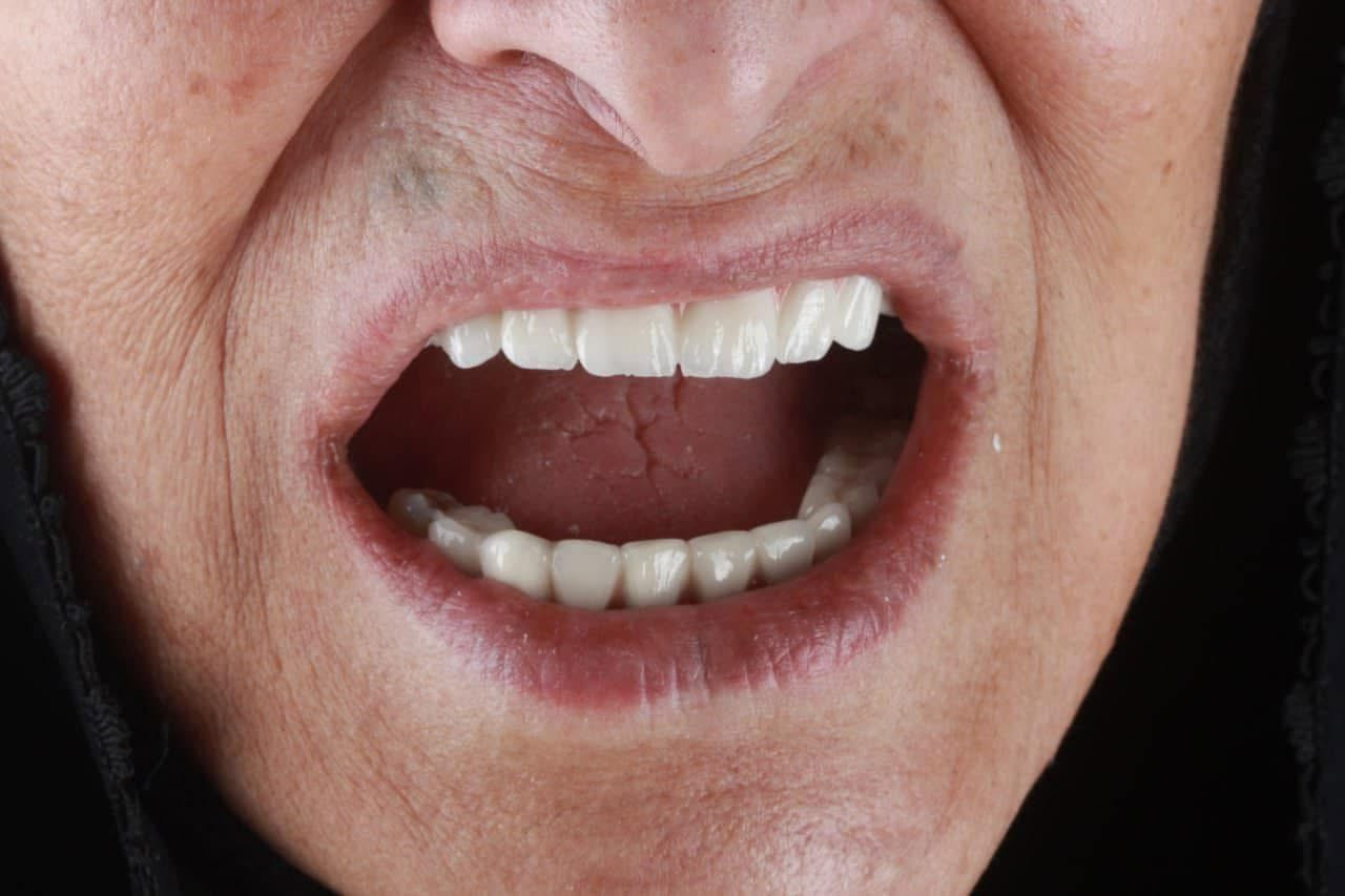 تعلن عيادتنا لزراعة وتجميل الاسنان عن خصم يصل الى اكثر من 50% على زراعة الاسنان ✨🤍

وتعلن ايضاً عن توفير نظام الاقساط المريح الى حملة ماستر كارد الرافدين 💳

✅زراعة الاسنان الفورية ( الالمانيه- السويسرية-الكوريه)

خلال ٧ ايام وبدون ألم وبدون فتح اللثه
امنة لمرضى السكري والضغط والتهابات اللثة الحادة
مناسبة جدأ للمدخنين

✅تركيب الاسنان الثابتة ( سيراميك-زاركون-ايماكس)

✅تقويم الاسنان (عادي-شفاف) وبالاقساط المريح

✅حشوات ضوئية ( كمبزت ) بجلسة واحدة 

✅حشوة جذر وبجلسة واحدة ان امكن

العنوان/ الديوانية - حي الحضارة 

للحجز والأستفسار مراسلة الصفحة لطفاً او الاتصال على 
***********

#تركيبات_اسنان #تسوس_الأسنان #ابتسامه_هوليود #اسنان #زراعه_الاسنان #تغليف #الديوانيه
