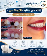 تغليف الإيماكس • حشوة جذرية • د محمد ناصر