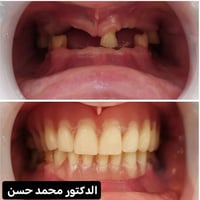 علاج مجاني • تعويض أسنان • بغداد الدورة
