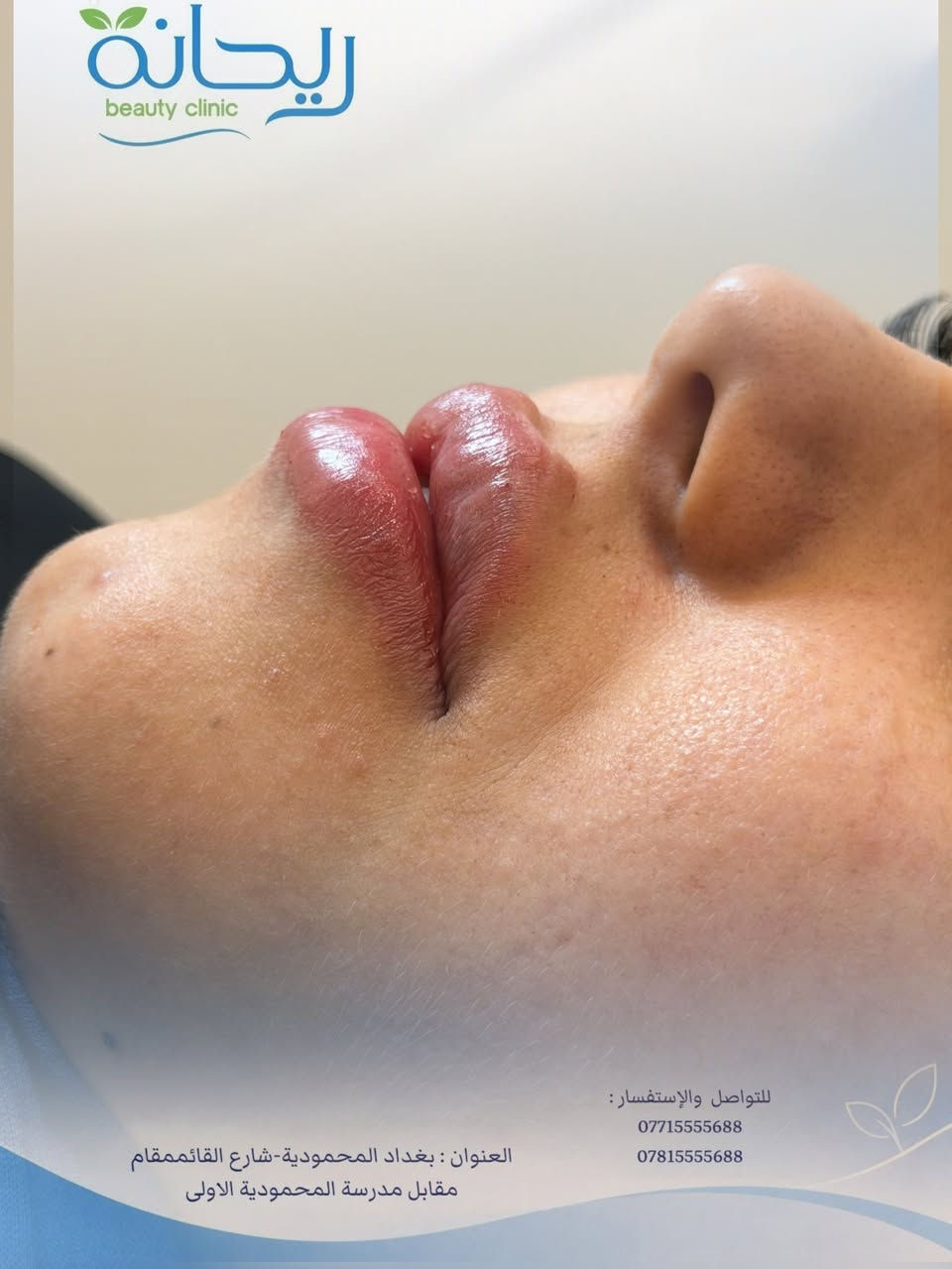 فلر شفه بيد دكتوره شوق💉♥️
العنوان: بغداد - المحمودية - شارع القائممقام - مقابل مدرسة المحمودية الاولى

ارقام الحجز: 
***********
***********
#الشعب_الصيني_ماله_حل😂😂 #العراق_السعودية_قطر_الامارات_الكويت_البحرين_اليمن_الخليج_سوريا_مصر_لبنان_الجزائر_تونس_المغرب_قطر_دبي #اكسبلور_فولو

نص مكتوب في الصور:
- ريحانة beauty clinic العنوان : بغداد المحمودية-شارع القائمقام مقابل مدرسة المحمودية الاولى للتواصل والإستفسار: *********** ***********
- ريحانة beauty clinic
- للتواصل والإستفسار:
- العنوان : بغداد المحمودية-شارع القائممقام مقابل مدرسة المحمودية الاولى