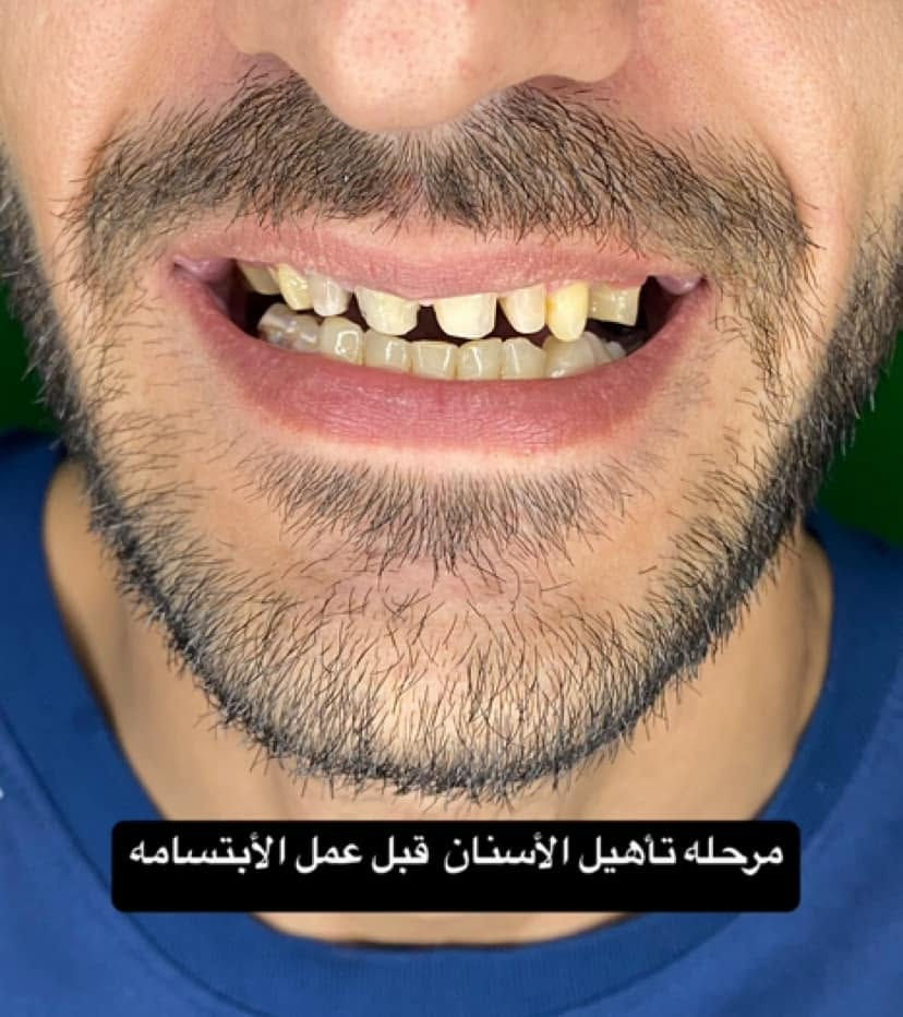 ابتسامة هوليود • زاركون ايماكس • ضمان مدى الحياة