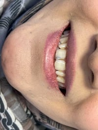 حشوات تجميلية • سنان امامية • الطوبجي