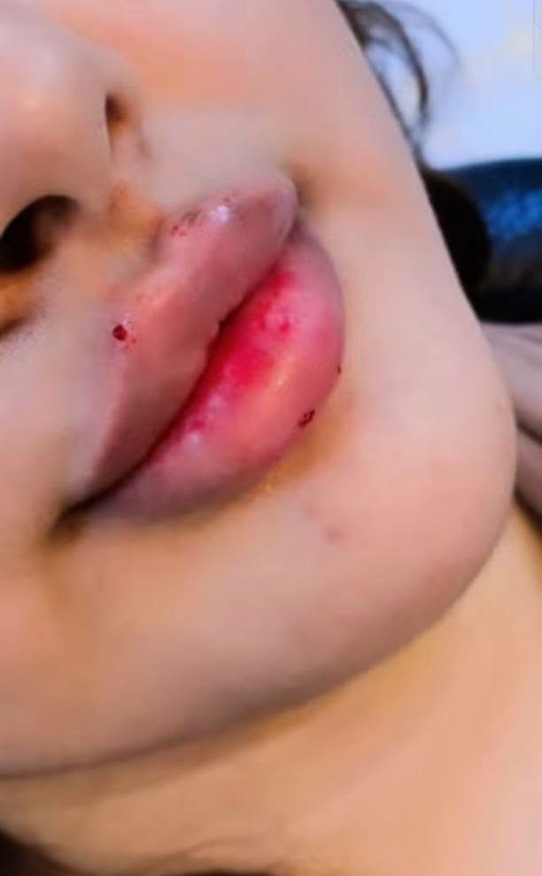جمال الفلر بيد خبيرة التجميل عروضنا مستمرة مع احلى الرسمات الكرزية 🦋🦋

نص مكتوب في الصور:
- قبل الحقن