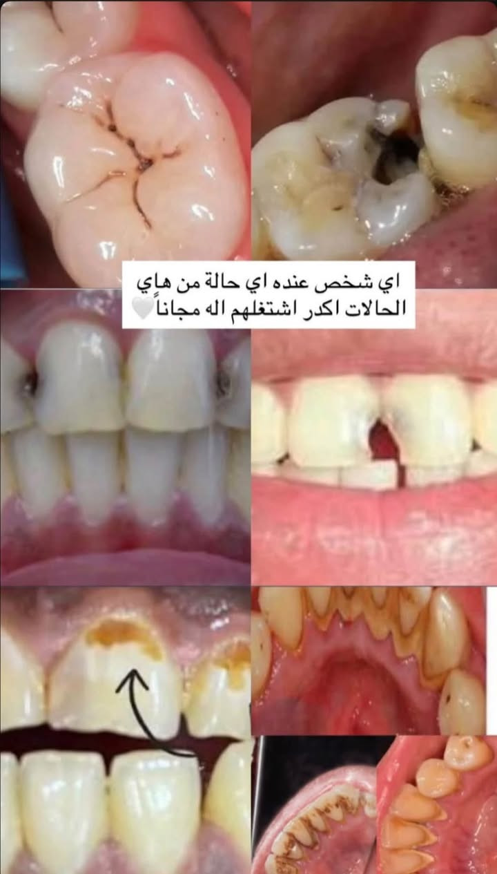 علاج اسنان • مجاني • عيادات جامعة الزهراوي