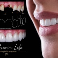 زراعة اسنان • تقويم اسنان • هوليود سمايل