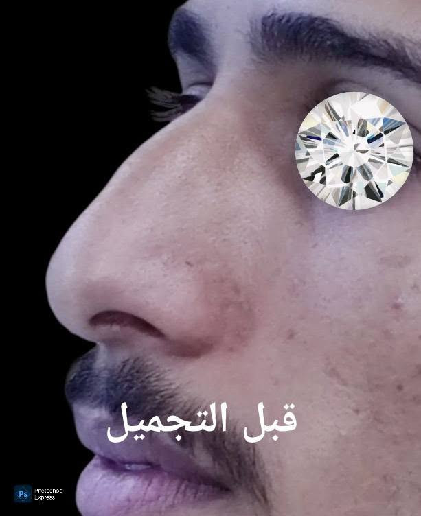تجميل الانف • طبيعي • قبل وبعد
