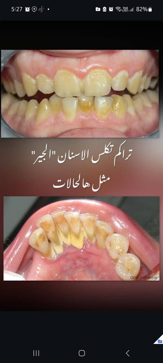 تنظيف الأسنان • إزالة التكلسات • جامعة اوروك