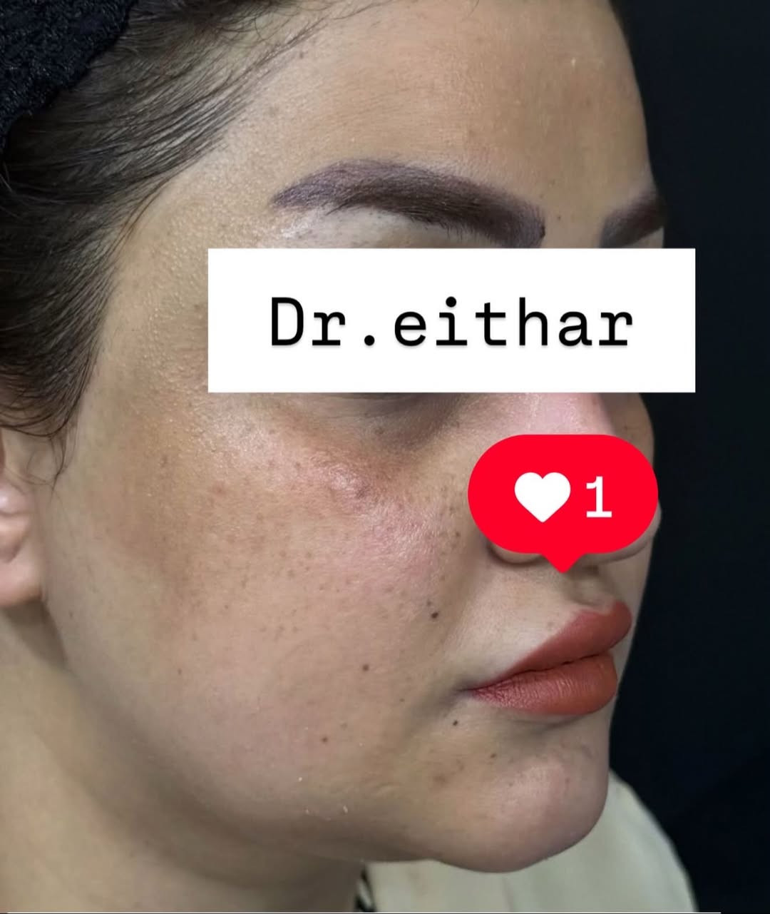 كونتور الوجه بالفلر  (لفتنك وجنات  واصداغ وتدوير الفك والذقن ونظاره وشفة قبل ٣ سنين حاقنتهه الهه مجددناه  ) 🔥🔥
لاحضو الفرق بالذقن ومنطقه الفك والوجنات شكد تغير الشكل🔥
عروووض للكادر التدريسي والخريجات والموظفات والعروسات  ثبتتهه الكم بالستوري بالهايلايت وببوست اعلى الصفحة ✨✨

د.ايثار سامي عبد الامير
واسط الكوت الهوره مجمع القبطان طابق اول 

الحجز***********
