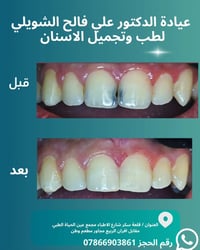 حشوات تجميلية • علاج التسوس • قلعة سكر