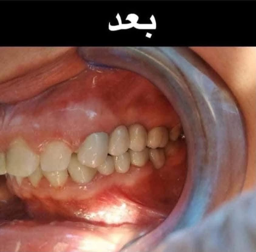 اللي يريد يحجز يتصل او يدز عالخاص
عيادة طب الاسنان 
تقويم الاسنان ،، زراعة الاسنان ،، حشوات تجميلية
تركيب الاسنان (سيراميك و زارگون)،، حشوات جذور ،، قلع،، حشوات مؤقتة ودائمية ،، تنظيف وتلميع الاسنان ،، تبييض الاسنان بالليزر 
متواجدين طيلة أيام الاسبوع 
للحجز والاستفسار ع الخاص او ع الرقم 
*********** واتساب 
العنوان .. الامين الثانية شارع البنازيخانة يم السوگ 
قریب ع افران السلام واسواق الشارقة مقابل محلات الصبيحاوي
مجمع دكتورة رجاء محمد نصيري
