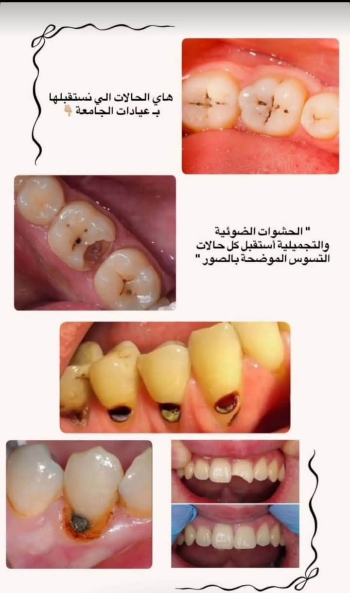 علاج الأسنان بشكل مجاني
وبإشراف أطباء إختصاص للي محتاج أي من الحالات التالية :
حشوات ضوئية (بيضه )
قلع الأسنان التالفة و الجذور
طقم جزئي متحرك
تنظيف الأسنان ( للي عنده تكلسات)

لحجز موعد التواصل مع الحساب 
تلواصل
 فيس Rana Ahmed
@dr_rana_dentalانستا 
تلي @Rayoun55
***********

نص مكتوب في الصور:
- قلع الأسنان التالفة والجذور المتبقية
- أزالة التكلسات والترسبات وتنظيف الاسنان " Dr Lobna K.
- هاي الحالات الي نستقبلها ب عيادات الجامعة  👇 الحشوات الضوئية والتجميلية أستقبل كل حالات التسوس الموضحة بالصور "
- نباوي❤️
- قبل ٥٣ دقيقة
- متوفر طقم جزئي للحالات: