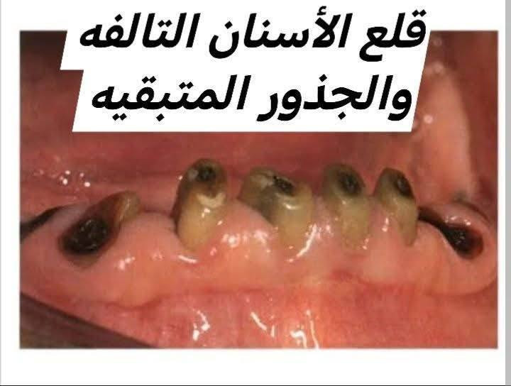 تنظيف تكلسات • حشوات ضوئية • علاج مجاني