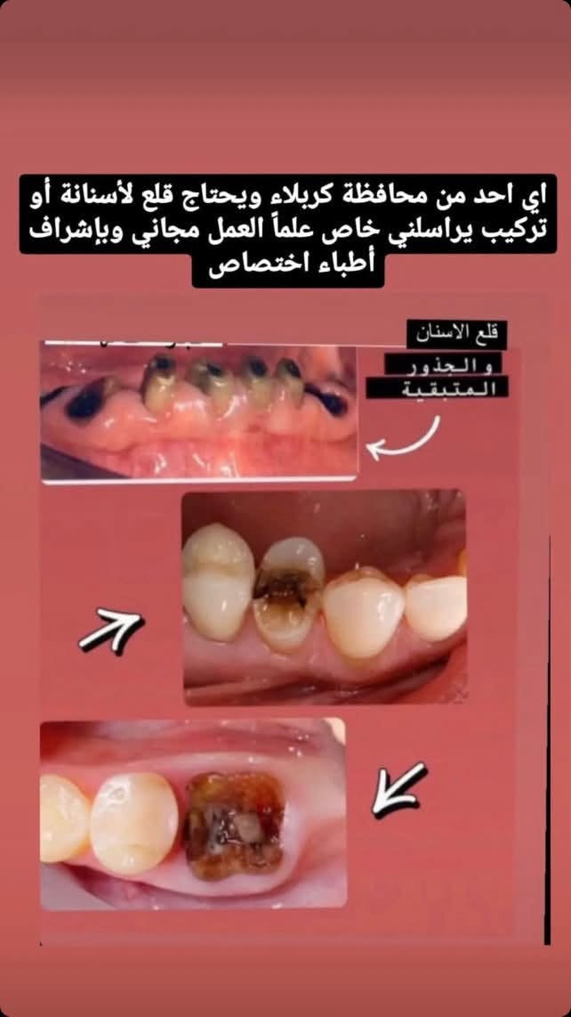 كربلاء • قلع الاسنان • مجاني