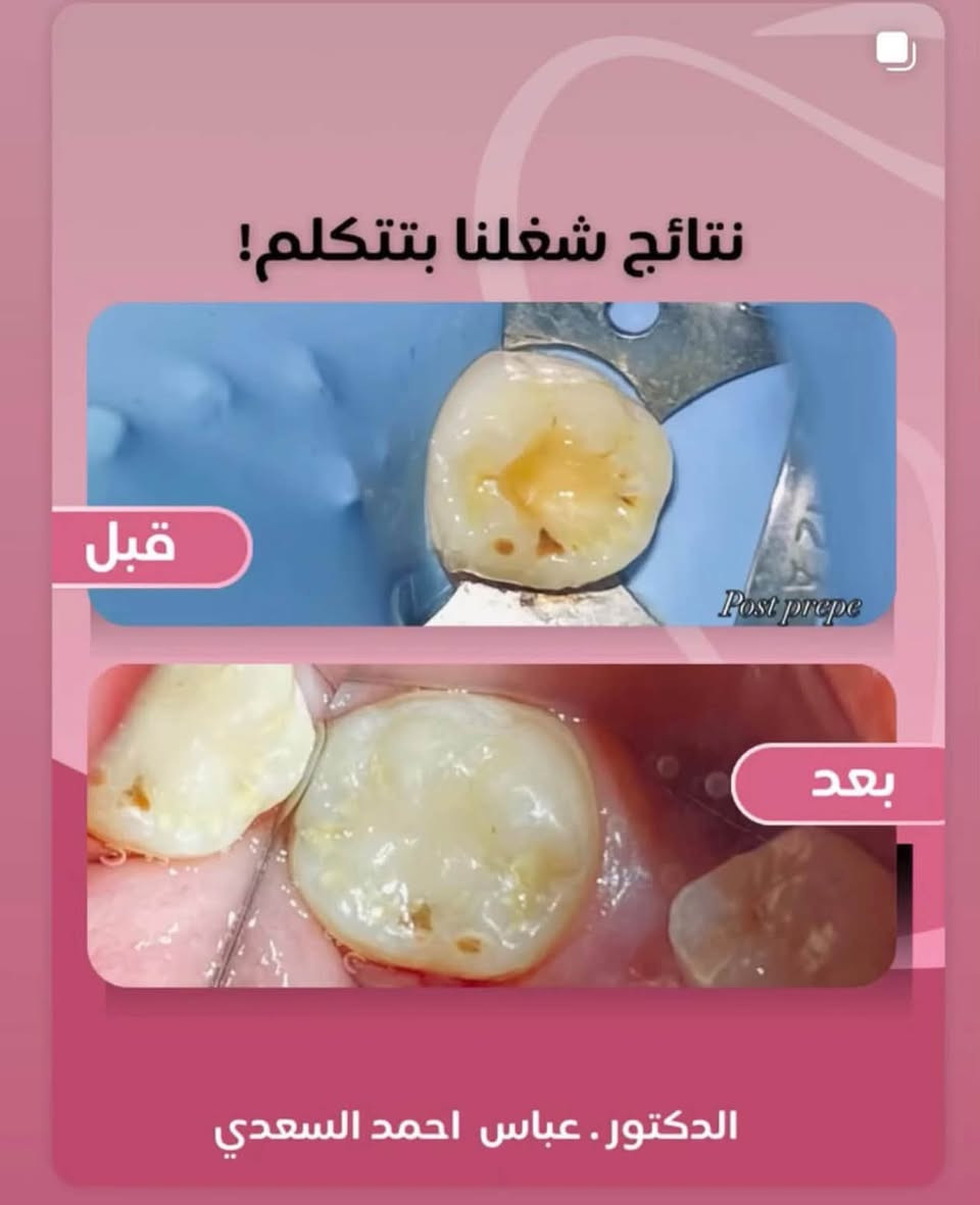 � هل تعاني من ألم بالأسنان أو تحتاج إلى علاج؟
إذا عندك مشكلة بأسنانك، لا تأجلها لحد ما تكبر المشكلة.

🔹 علاج وقلع الأسنان
🔹 الحشوات والعلاجات التجميلية
🔹 علاج وخدمات أسنان الأطفال 🧒🏻
🔹 الأطقم المتحركة الكاملة 🦷
🔹 فحص وتشخيص الحالات

العلاج مجاني ‼️

👨🏻‍⚕️ تحت إشراف أطباء أسنان مختصين

📍 عيادات جامعة الهادي – الدورة – نهاية شارع 60

📩 للحجز والاستفسار راسلوني خاص او الاتصال على الرقم 📞 ***********

الدكتور عباس أحمد السعدي 🦷

نص مكتوب في الصور:
- ابتسامتك تستحق العناية قبل بعد الدكتور.عباس احمد السعدي
- Before After د. عباس أحمد السعدي أخصائي طب الأسنان
- نتائج شغلنا بتتكلم!
- قبل
- بعد
- الدكتور . عباس احمد السعدي
- ابتسامتك تستحق العناية
- د.عباس احمد السعدي