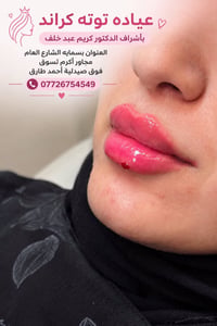 عيادة توته • فيلر الشفايف • بسماية