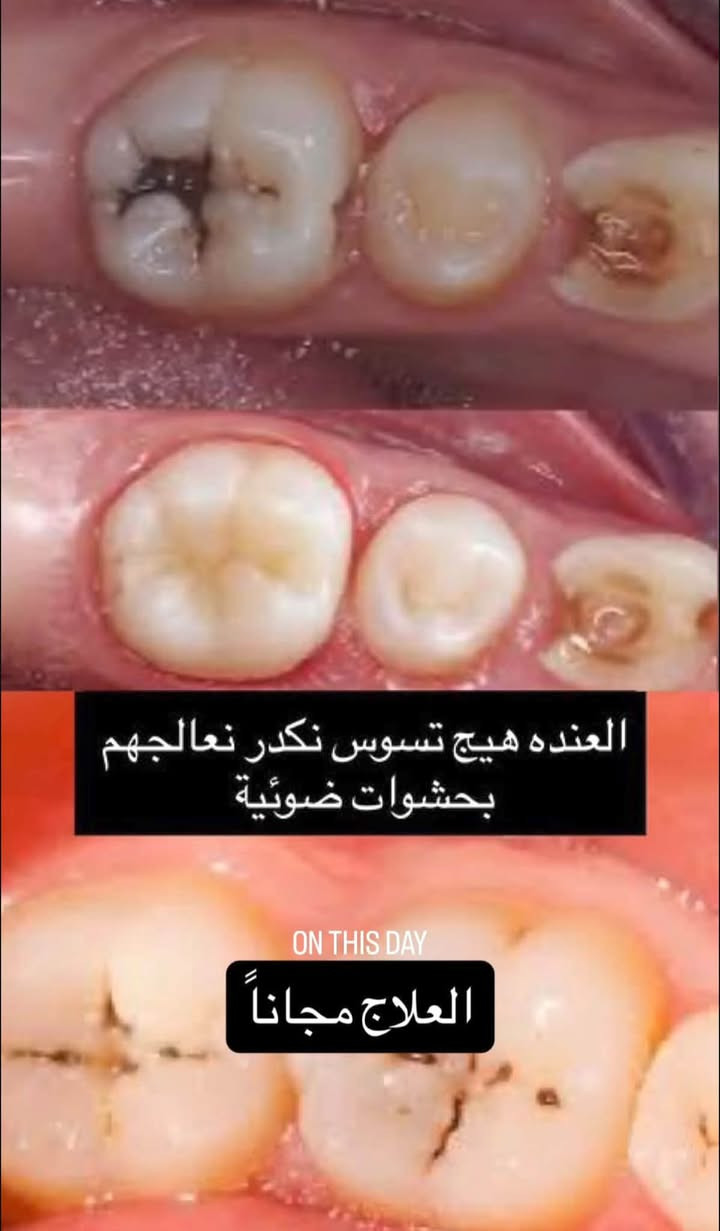 جامعة الكوفة عيادات طب الاسنان
‎السلام علیکم

‎قلع الاسنان التالفه وبقايا الجذور وتعويضها بطقم اسنان

‎حشوات دائمية ضوئية للكبار والاطفال

‎تنظيف الاسنان من التكلسات والتصبغات

‎علماً العلاج مجاناً وتحت اشراف اطباء مختصين الموقع / عيادات جامعة الكوفة خلف كلية الفقه للحجز والاستفسار دايركت

‎*********** واتساب

نص مكتوب في الصور:
- تعويض الأسنان المفقودة بطقم كامل
- تنظيف الأسنان من التكلسات
- مثل :
- before
- after
- العنده هيج تسوس نكدر نعالجهم بحشوات ضوئية ON THIS DAY العلاج مجاناً