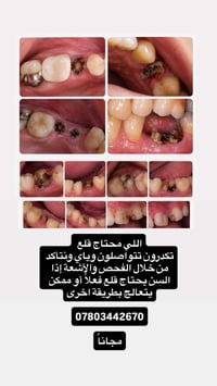 مجاناً • قلع أسنان • جامعة الكنوز