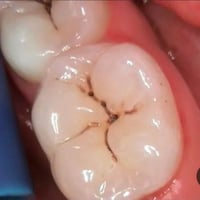 تسوسات • حشوة سن • علاج تسوس