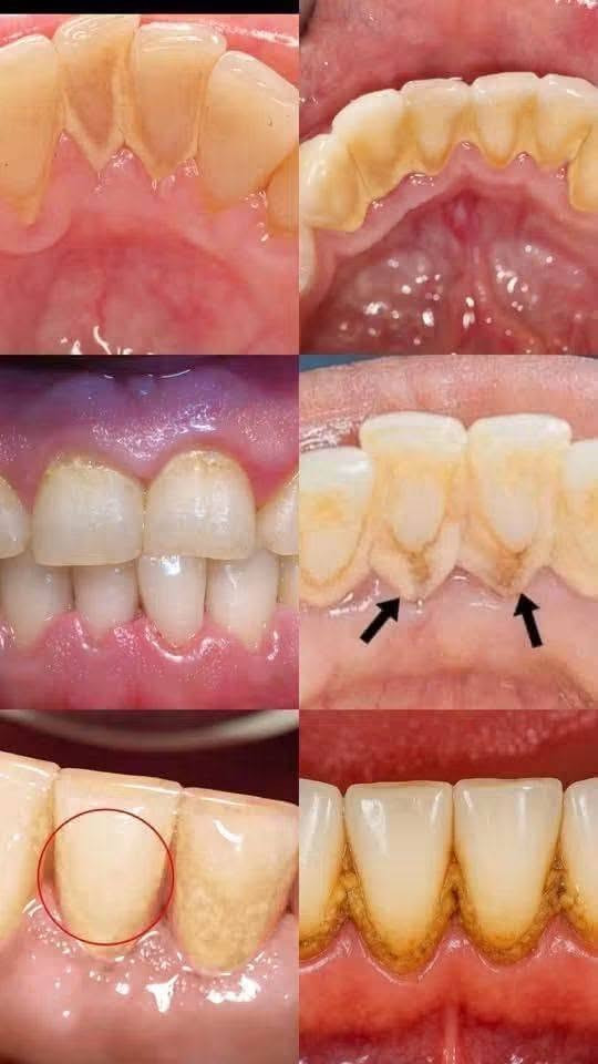 السلام عليكم
إعلان عن علاج أسنان مجاني بالكامل
تعلن عيادات كلية طب الأسنان في جامعة المستقبل عن تقديم خدمات قلع الأسنان والتنظيف والحشوات مجانًا بالكامل وتحت إشراف كادر طبي متميز ومختص.
الحالات المشمولة بالقلع:
الأضراس أو الأسنان المتبقية عبارة عن جذر فقط.
الأسنان التي تحتوي على حركة (غير ثابتة).
الأسنان المصابة بتسوس عميق وتتطلب القلع.
ويتوفر أيضا تنظيف الاسنان 
وعمل حشوات ضوئيه 
عمل طقم اسنان متحرك 
إذا كانت لديك إحدى هذه الحالات وتود حجز موعد، يرجى التواصل وتسجيل البيانات عبر الواتساب:
📱 رقم التواصل: [***********]
المكان: جامعة المستقبل - عيادات كلية طب الأسنان.
