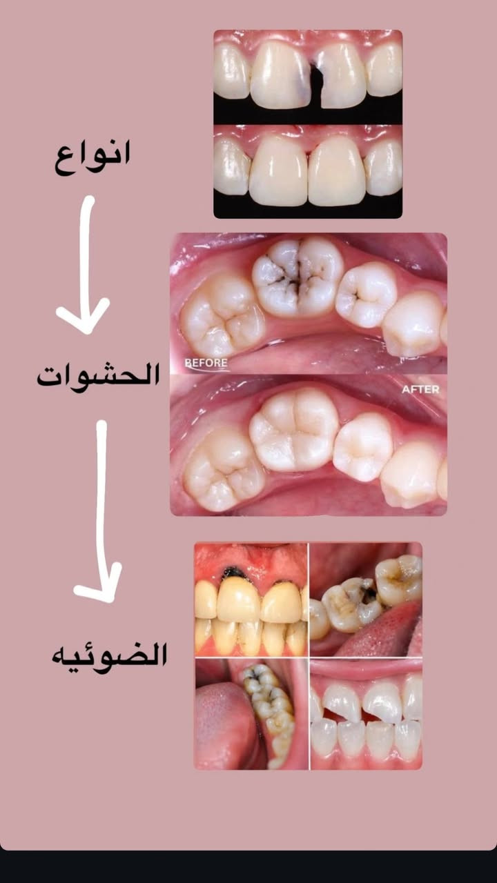 قلع أسنان • علاج مجاني • كربلاء عمود١١١١