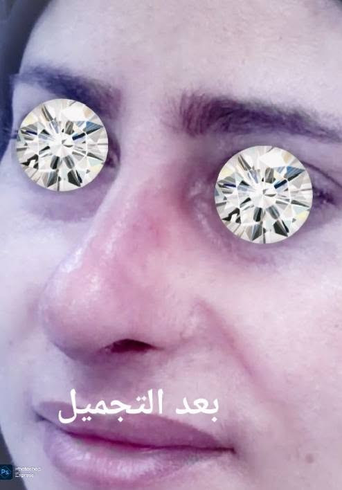 ترميم الأنف • تجميل أنف ثانوي • عيادة الياسيري