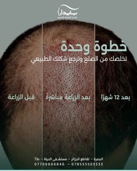 زراعة شعر • البصرة • نتيجة ١٢ شهر