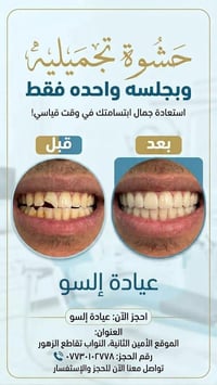 حشوة تجميلية • تنظيف أسنان • جلسة واحدة