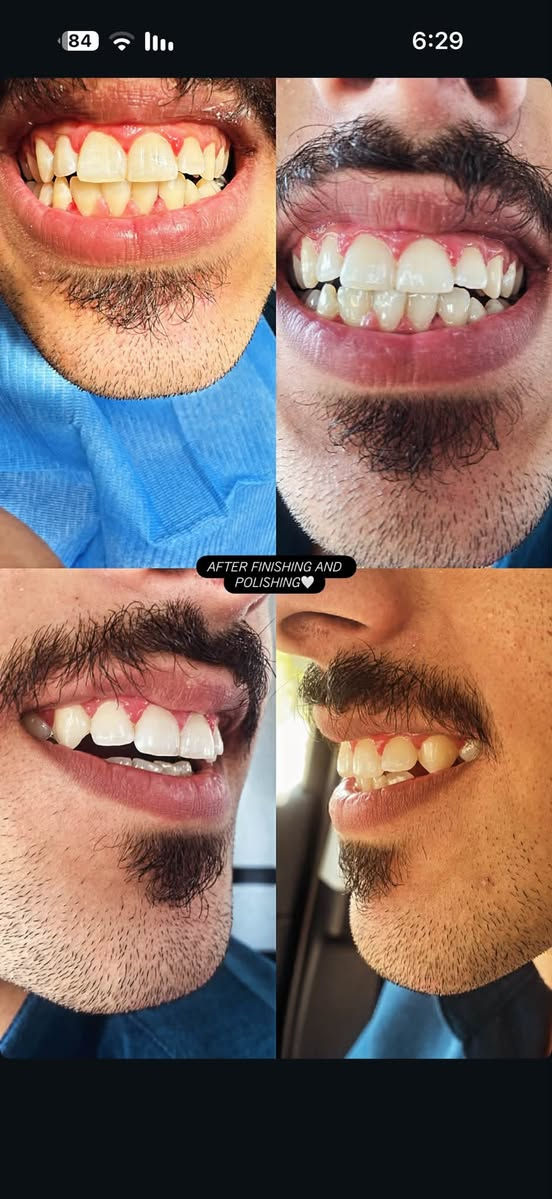 عيادات جامعة البيان • د.إبراهيم أحمد نوري • حشوات وتبييض
