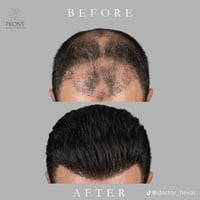 زراعة شعر • أربيل شورش • مركز بيوني
