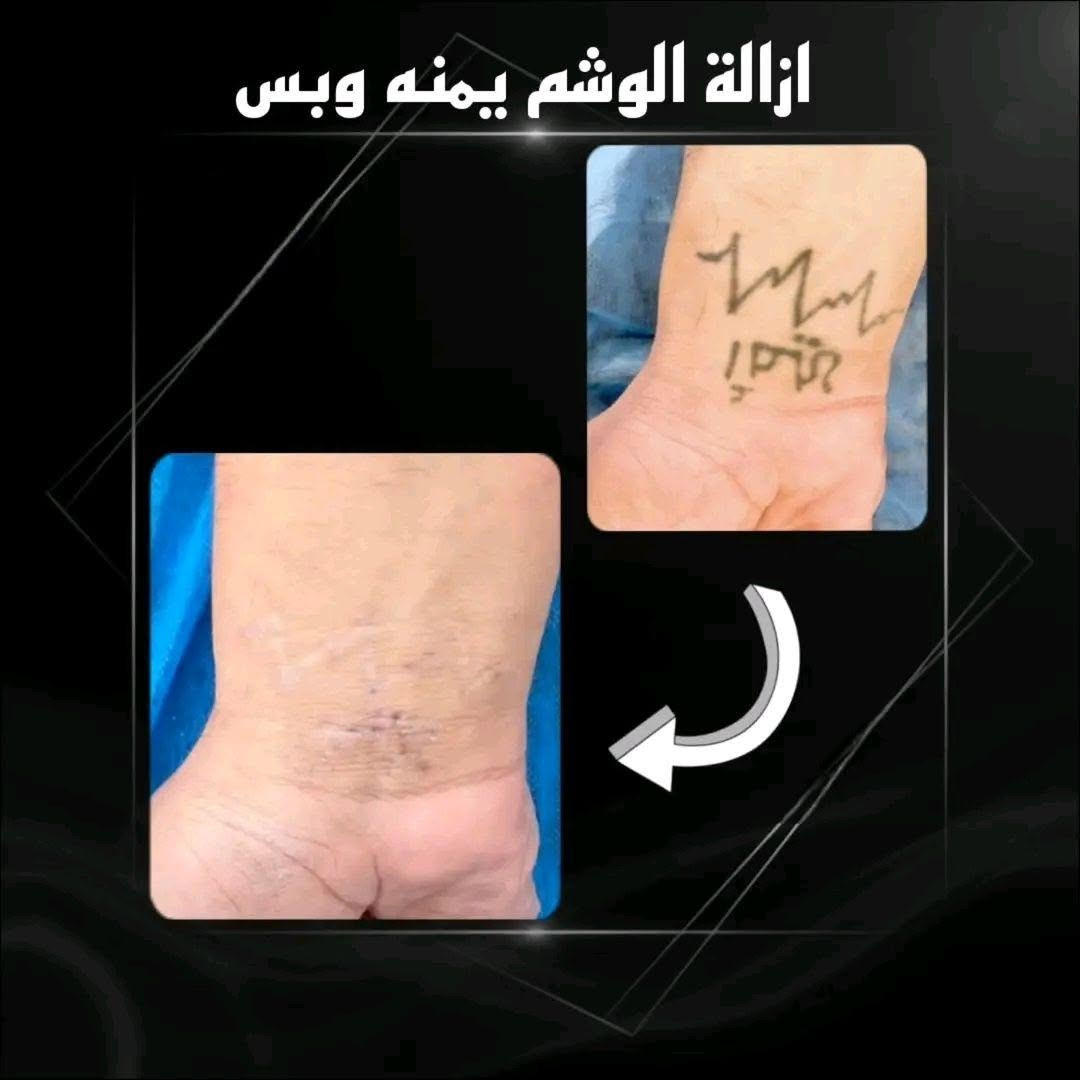 مستعدون لازالة جميع انواع الوشوم القديمة والحديثة بآحدث الأجهزة 
البصرة الجمهورية شارع الاطفاء مقابل ريتاج سنتر قرب حسينية البتول عليها السلام 
*********** البصرة, العراق

نص مكتوب في الصور:
- ازالة التاتو بالليزر
- ازالة الوشم يمنه وبس