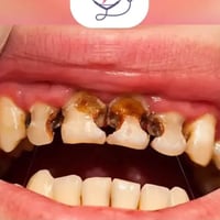 علاج تسوسات • مجاني • الدورة جامعة دجلة