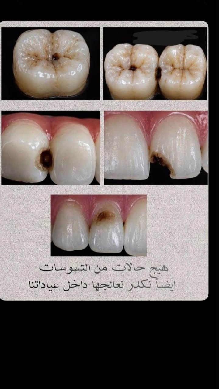 دكتورة آيات • طقم أسنان • قلع أسنان