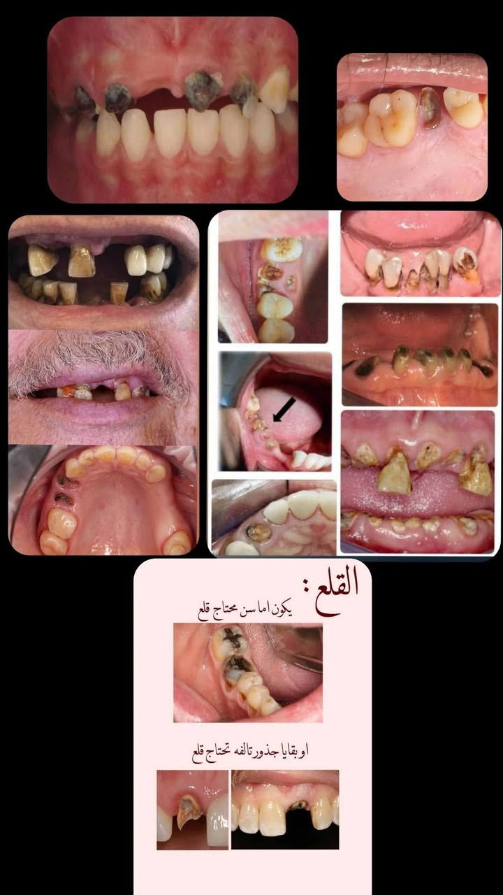 السلام عليكم ورحمة الله وبركاته
اي أحد محتاج علاج لاسنانة
حشوات ضوئية ممتازة ✅
تنظيف الأسنان
قلع الجذور و الاسنان التالفة

طقم جزىي متحرك مكان الأسنان المفقودة ✅🦷

نص مكتوب في الصور:
- السلام عليكم
- اي أحد محتاج قلع لأنانة
- سواء جذر باقي
- او سن يتحرك
- او سن تالف
- العلاج مجاني بالكامل
- المواقع
- عيادات جامعة آشور قرب كراج
- العلاوي، شارع مطار المثنى
- الوقت ، غداً الساعة 12
- 10/4
- للتواصل واتساب
- ***********
- القلع: يكون اما سن محتاج قلع او بقايا جذور تالفه تحتاج قلع