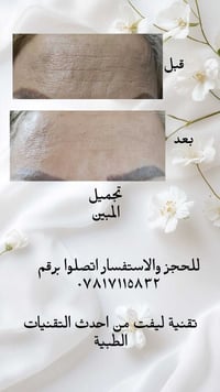 ليفت الجبين • بليزر • حجز مسبق
