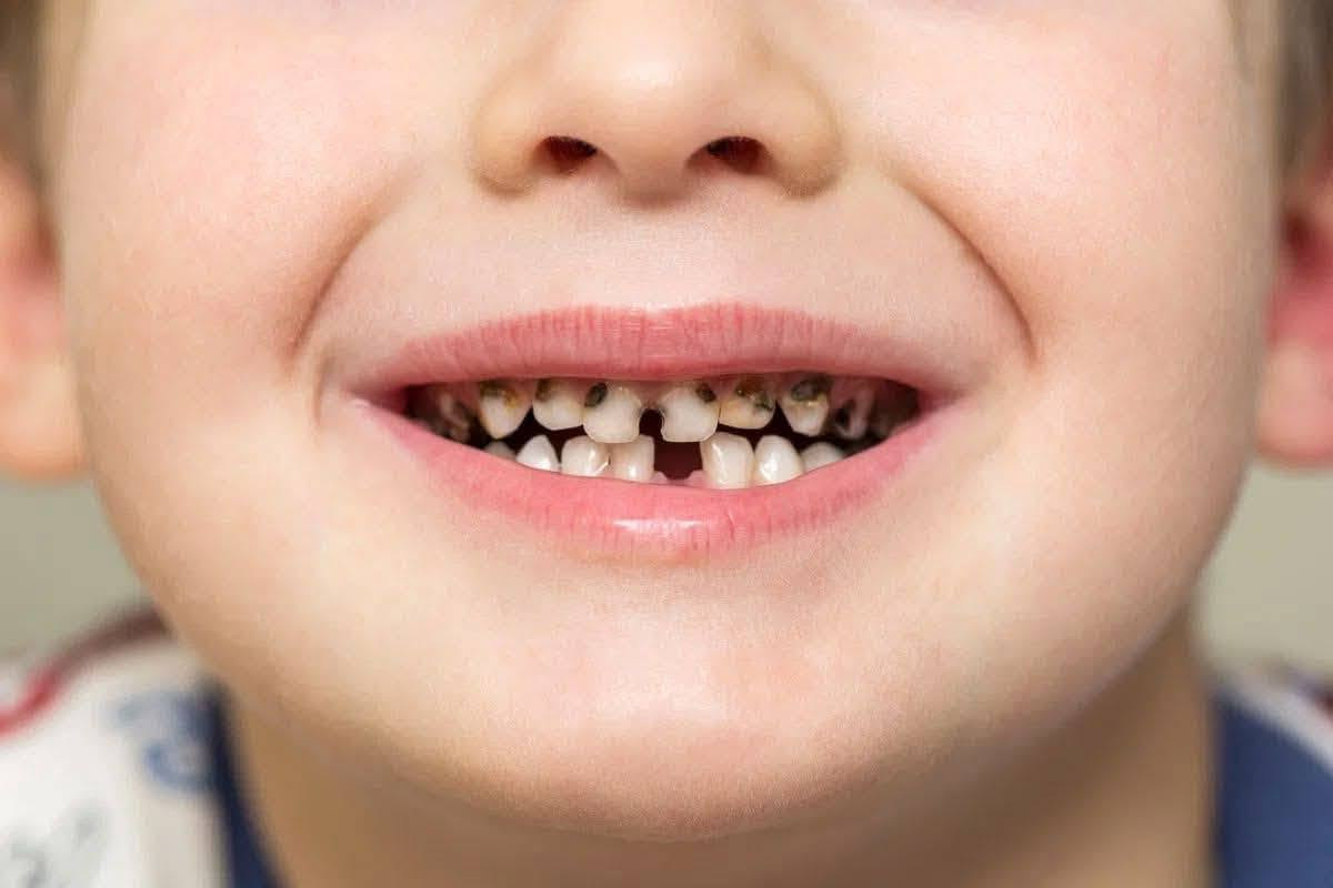 علاج أسنان أطفال • كلية طب الأسنان • الرمادي