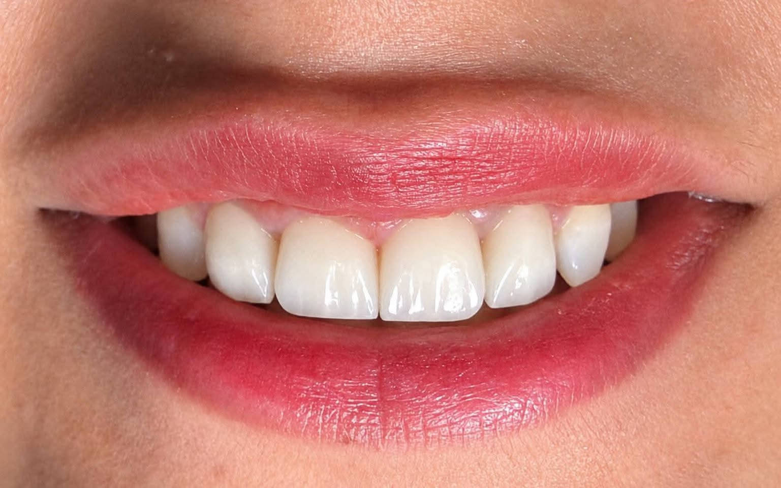 تغليف زيركون • حشوات تجميلية • ميسان الماجدية