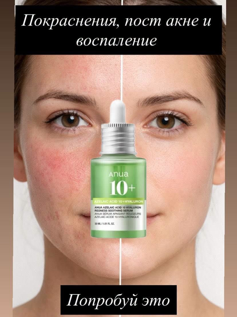 ✨ بشرتج صافية وأهدى؟ 😍💚

سيروم ANUA Azelaic Acid 10% ✨
🌟 يساعد على توحيد اللون وتخفيف التصبغات
💚 يقلل الحبوب والاحمرار
💧 يرطب ويخلي البشرة أنعم وأنضر

مناسب للبشرة الحساسة والمعرضة للحبوب 👌
🔥 خلي بشرتج تحچي عن النضارة!
___________________
متوفر لدينا خدمة توصيل لجميع المحافظات
للحجز والاستفسار يرجى الاتصال او مراسلتنا عبر الواتساب عن طريق الرقم
***********
أو عن طريق الرابط التالي 
https://wa.me/message/J5VDN4SJX4IXC1
او عن طريق الانستقرام 👇👇
https://instagram.com/cosmatic_lamasat1?igshid=MzRlODBiNWFlZA==
