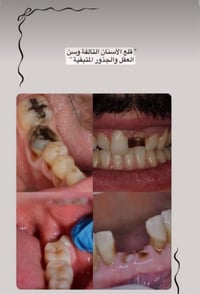 علاج أسنان مجاني • قلع جذور • دكاترة اختصاص