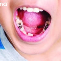 حشوات اطفال • مجانا • واتساب