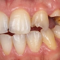 🦷 من أسنان متضررة… إلى ابتسامة متناسقة ✨  بناء الأسنان وإعادة تشكيلها،...