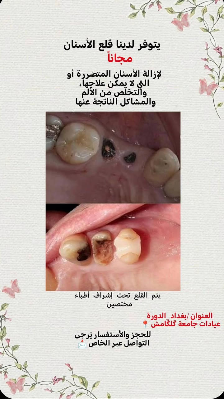 حشوات ضوئية • تنظيف أسنان • بغداد الدورة
