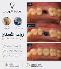 ⁨ 🔥🔥🔥🦷 زراعة الأسنان | عيادة الرباب  **فقدت سن؟ لا تخلي الفراغ يأثر عل...
